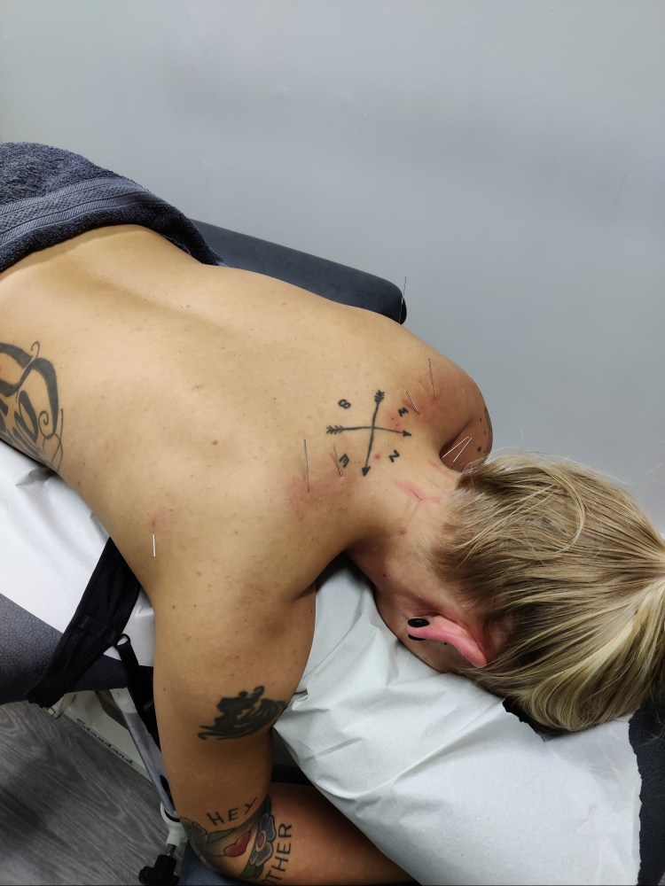 Dryneedling niska-hartiaseudun kireyksiin porvoo hieroja